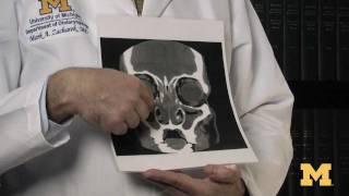 How do I know if I need sinus surgery?