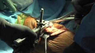 Total Knee Replacement Surgery Dr. Eric W. Janssen