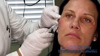 Painless, Non-surgical Facelift Elite Medical Aesthetics Rocklin Ray Bayati MD Cheek Augmentation