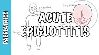 Acute Epiglottitis - signs and symptoms, causes, pathophysiology, treatment