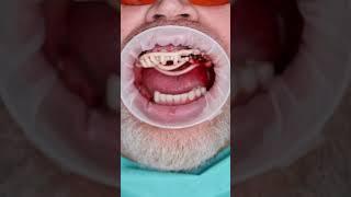 Dental implant’s in Prague #shorts #dentist #dental #implant #veneers #short