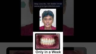 Full Mouth Dental Implant - Dr Mayur Khairnar