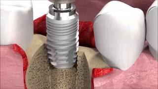 SIC invent Dental Implant Procedure: SICmax implant insertion