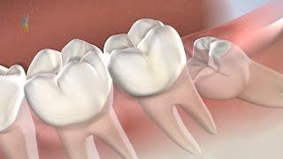 Wisdom Teeth Removal in Oklahoma City, OK | Oral Surgery Specialists of Oklahoma