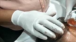 PRF Hair Growth Procedure, Hair Loss Treatment, Hair Regrowth, Surat, Gujarat, India.