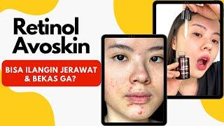 Review Retinol Avoskin Setelah Pakai 3 Bulan (Beneran Hilangin Jerawat & Bekas Ga?)