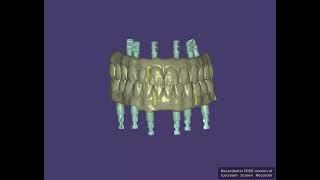 Full Mouth Implant bridge design