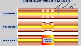 Seddon's Classification of Nerve Injury