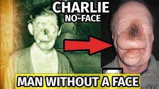 The Real Story of The Man Who Lived Without A Face - Charlie No Face