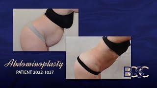 Full Abdominoplasty Including VASER Liposuction (Patient 2022-1037)