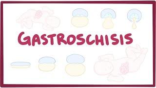 Gastroschisis - causes, symptoms, diagnosis, treatment, pathology