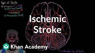 Ischemic stroke | Circulatory System and Disease | NCLEX-RN | Khan Academy