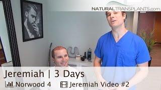 3 Days Post-Procedure - Natural Transplants, Hair Transplant Miami Florida (Jeremiah)