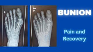 Minimally Invasive Bunion Surgery | Pain and Recovery