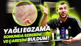 Seboreik Dermatit (Yağlı Egzama) Hastalığı İle Alakalı 30 Yıllık Tecrübelerim!