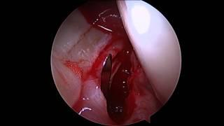 Joshua Harris, MD - Interportal capsulotomy (2)