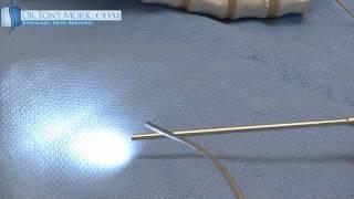 The Endoscope for Laser Spine Surgery