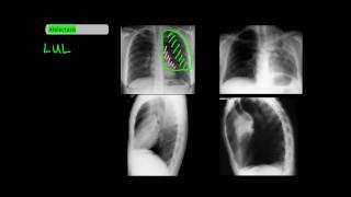 Lobar Atelectasis on Frontal and Lateral Chest X-Rays [UndergroundMed]