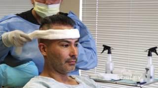 BOSLEY FUE Edgar's Journey (Follicular Unit Extraction): Hair-by-Hair Restoration (Hair Transplant)