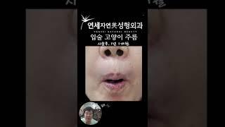 입술 세로주름의 영구적교정 #연세자연미성형외과 #고양이주름#인중주름#치마주름#신촌성형외과 #홍대성형외과