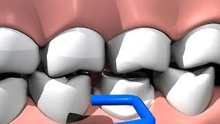 PrepSure occlusal adjustment instruments.