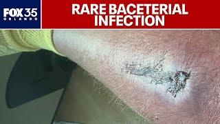 Rare bacterial infection strikes Florida man after Lake Dora Jet Ski injury