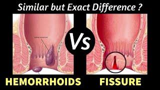 Hemorrhoids Vs Fissure ? Learn EXACT Difference I Symptoms ? Anal pain ?