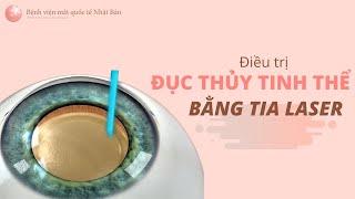 LASER CATARACT - Điều trị ĐỤC THỦY TINH THỂ bằng Laser | Bệnh viện mắt quốc tế Nhật Bản