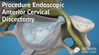 Procedure Endoscopic Anterior Cervical Discectomy