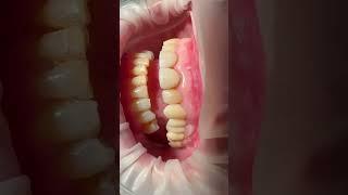 Provisional Crown Vertiprep #dentistry #restorativedentistry #prosthodontic #dentalcrowns #shorts