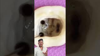 Root canal treatment processing step by stepll#dentist #rootmodification#gingivectomy k p techblock