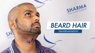 Beard to Scalp Hair Transplant