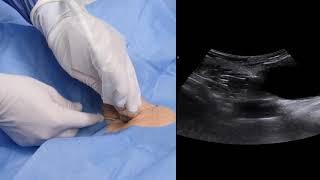 Microconvex Probe Internal Jugular Vein Central Venous Catheterisation