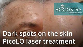 Dark spots on the skin - PicoLO laser treatment (21085)