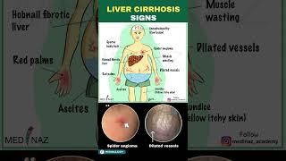 Signs of Liver Cirrhosis | Cirrhosis of the liver | Liver Disease #cirrhosis #shorts #liverhealth