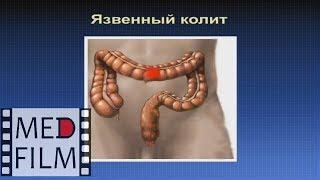 Клиническая картина язвенного колита - НЯК © Ulcerative colitis