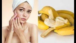 How to treat acne with banana! | Fatima’s Journey