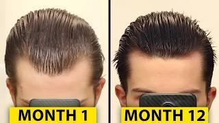 How I Regrew My Hair | Hair Surgeon Reacts