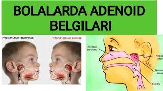 BOLALARDA ADENOID BELGILARI