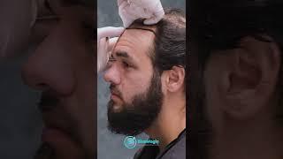 New Hair Restoration Technology Available in Turkey