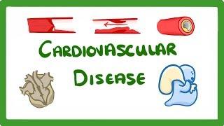 GCSE Biology - Why Do We Get Heart Disease and How to Treat It? - Cardiovascular Disease (CVD)