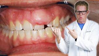 Dentist Explains Swollen Gums & Why They are Inflamed, Puffy, Irritated & Sore! Gingivitis Reasons!