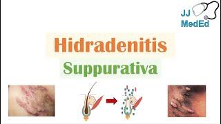 Hidradenitis Suppurativa (HS) | Pathophysiology, Triggers, Signs & Symptoms, Diagnosis, Treatment