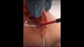 Earwax removal of large piece of wax