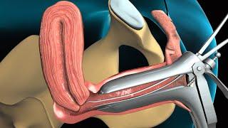 Endometrial Biopsy