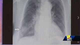 Don't ignore the symptoms: Pneumonia can be very serious