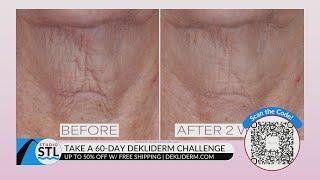 Take the 60-day Dekliderm challenge and experience youthful skin!