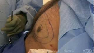 Male breast reduction using Ultrasonic Liposuction