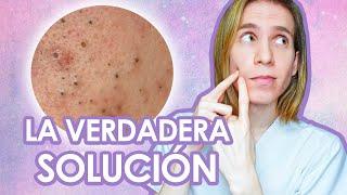 BLACKHEADS: How to treat and prevent open comedones