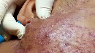 Mụn viêm, nang nặng, da hoại tử nghiêm trọng | Acne Treatment | Trị mụn hiệu quả TPHCM | HHV Clinic